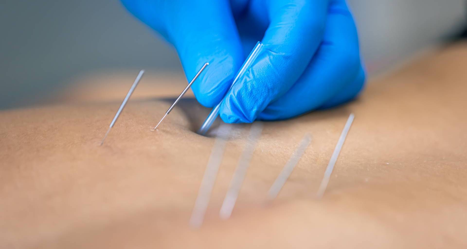 Китайская медицина — кетгут-терапия и акупунктурный лифтинг